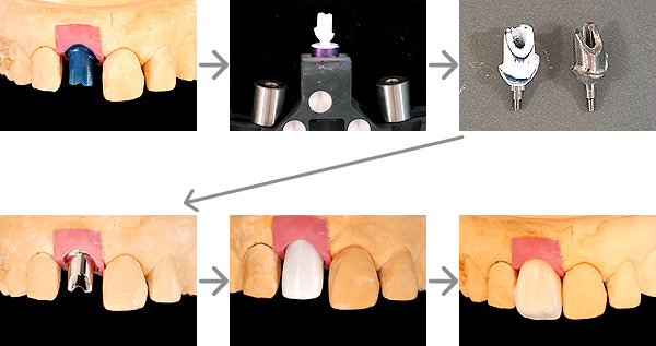 歯科技工アルタデントカムログインプラントUCLAアバットメント鋳接用 ...